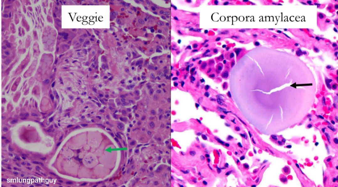 pathofishiology's tweet image. Since we have lung on our minds from Dr. @smlungpathguy &apos;s AWESOME #CAPVirtualPath lecture, I wanted to share a case that I had been obsessed with, to complement one of his slides! Microliths by comparison are usually larger, and corpora amylacea are not calcified!