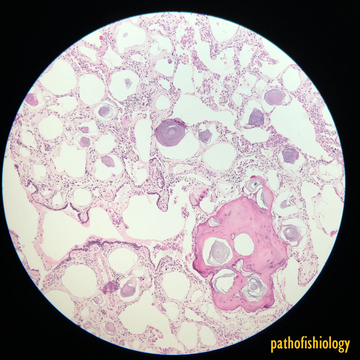 pathofishiology's tweet image. Since we have lung on our minds from Dr. @smlungpathguy &apos;s AWESOME #CAPVirtualPath lecture, I wanted to share a case that I had been obsessed with, to complement one of his slides! Microliths by comparison are usually larger, and corpora amylacea are not calcified!