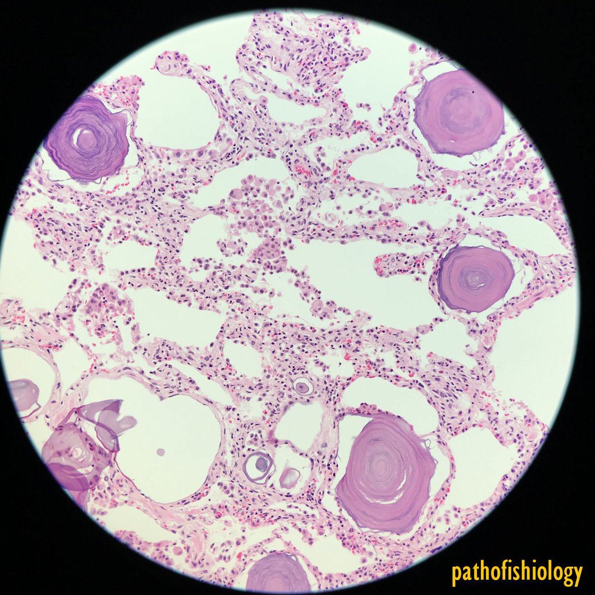 pathofishiology's tweet image. Since we have lung on our minds from Dr. @smlungpathguy &apos;s AWESOME #CAPVirtualPath lecture, I wanted to share a case that I had been obsessed with, to complement one of his slides! Microliths by comparison are usually larger, and corpora amylacea are not calcified!