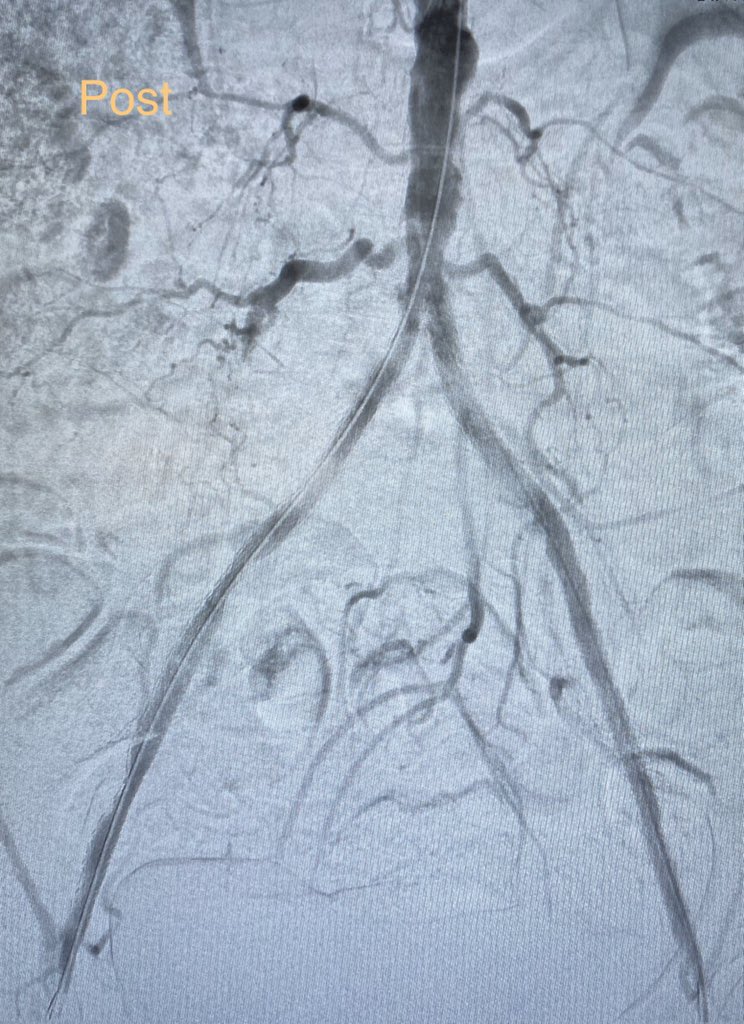 South Florida Vascular Specialists (@soflovir) on Twitter photo 62 y/o w/ former heavy smoking + DM w/ worsening intractable rest pain w/ multilevel dz including heavily Ca complete RCIA/EIA occlusion
<a href="/ShockwaveIVL/">Shockwave Medical</a> flattened Ca at low atmospheric (2-4atm) pressure facilitating covered stent revasc
<a href="/BOlivieriMD/">Brandon Olivieri</a> @OmoKinju <a href="/HeidyReynolds5/">Heidy</a> 62 y/o w/ former heavy smoking + DM w/ worsening intractable rest pain w/ multilevel dz including heavily Ca complete RCIA/EIA occlusion
<a href="/ShockwaveIVL/">Shockwave Medical</a> flattened Ca at low atmospheric (2-4atm) pressure facilitating covered stent revasc
<a href="/BOlivieriMD/">Brandon Olivieri</a> @OmoKinju <a href="/HeidyReynolds5/">Heidy</a>