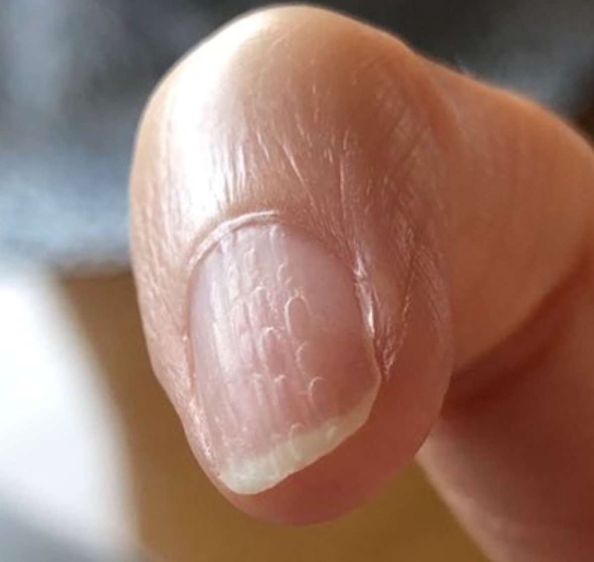 Cmk2wlさんのツイート 11年の福島原発事故後 こういったウロコ状の爪になった方は