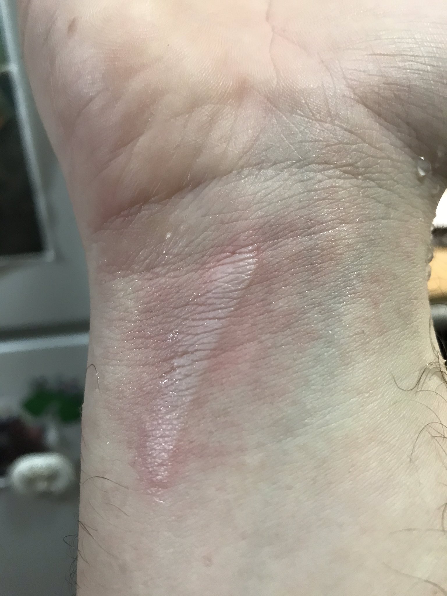 on Twitter "CW wound could be worse, but def