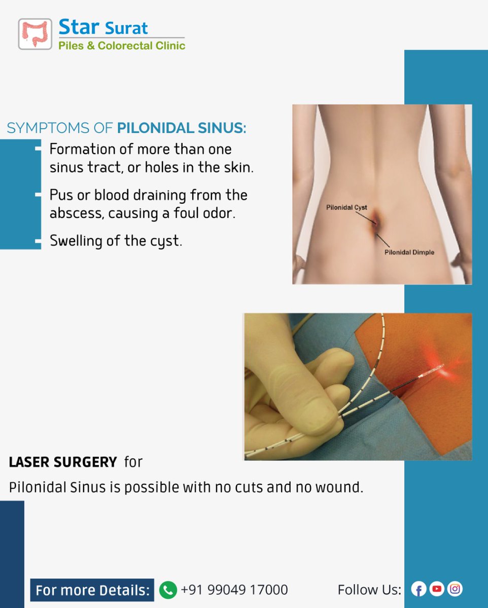 starsuratclinic's tweet image. 👨‍⚕️Symptoms of Pilonidal Sinus:

💁‍♀️Laser Surgery fo Pilonidal Sinus is possible with no cuts and no wound.

For more details Contact Us: 9904917000

#piles #pilonidal #pilonidalsurgery #pilonidalsinus #pilonidallasertreatmant #sinusinfection #sinusrelief #sinussurgery #RishiKapoor