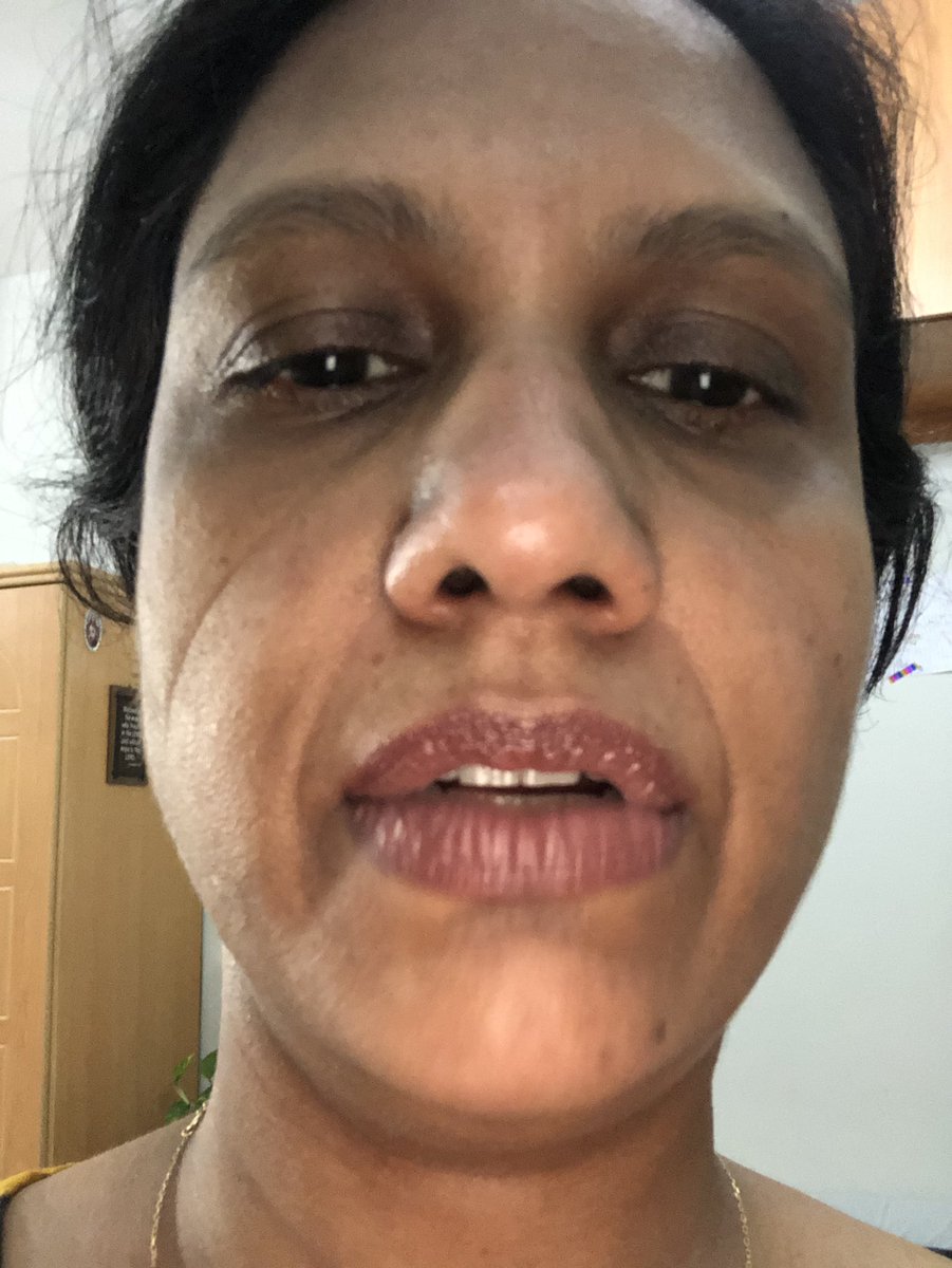 rrobe136's tweet photo. Stepped out for one hour and the mask left lines and dug into my face making me breathless. #Respect to the #frontliners and #HealthcareHeroes https://t.co/DTeOVBRBpI