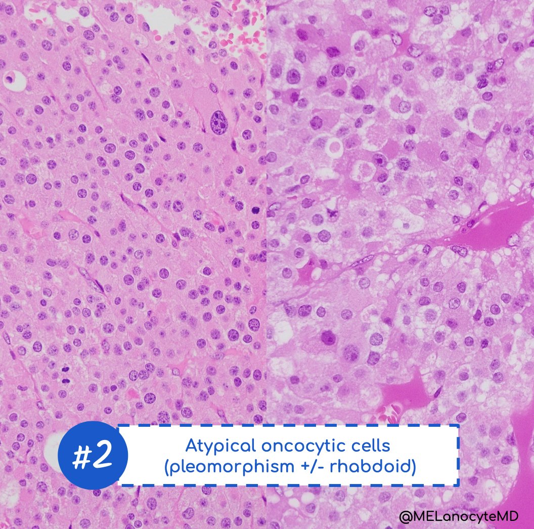 MELanocyteMD's tweet photo. Oncocytic adrenocortical carcinoma:
👩‍⚕️ Rare 🦓🦄
👩‍⚕️ Age~50, ♂️=♀️, 🚫fxn
👩‍⚕️ If >20 mitoses/50HPF ➡️ HG &amp; worse prognosis
📋 Criteria: LWB (🚫Weiss)
📸 Hemorrhage &amp; necrosis
🔬 Sheets, nests, cords
🔬 Atypia, dense pink CP
🔬 LVI
🎨 SYN, MART1, SRC1, SF1, inhibin #endopath #gupath https://t.co/OXBNbk4mDB