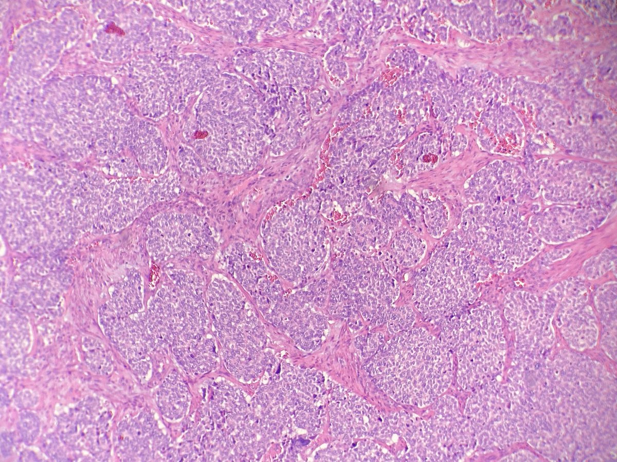 ac_pathgal's tweet photo. 60M. Partoid mass. @mhassanaimc @D_KumarMD @HansiniMD @PathologySayah @DrSamreenfatima @b_histopath @GagandeepkMD @doc_kartik @SwikrityUMD @SanicaBheleMD @SurgePath @vi_monappa @padmapathology1 https://t.co/tezPEaM7QS