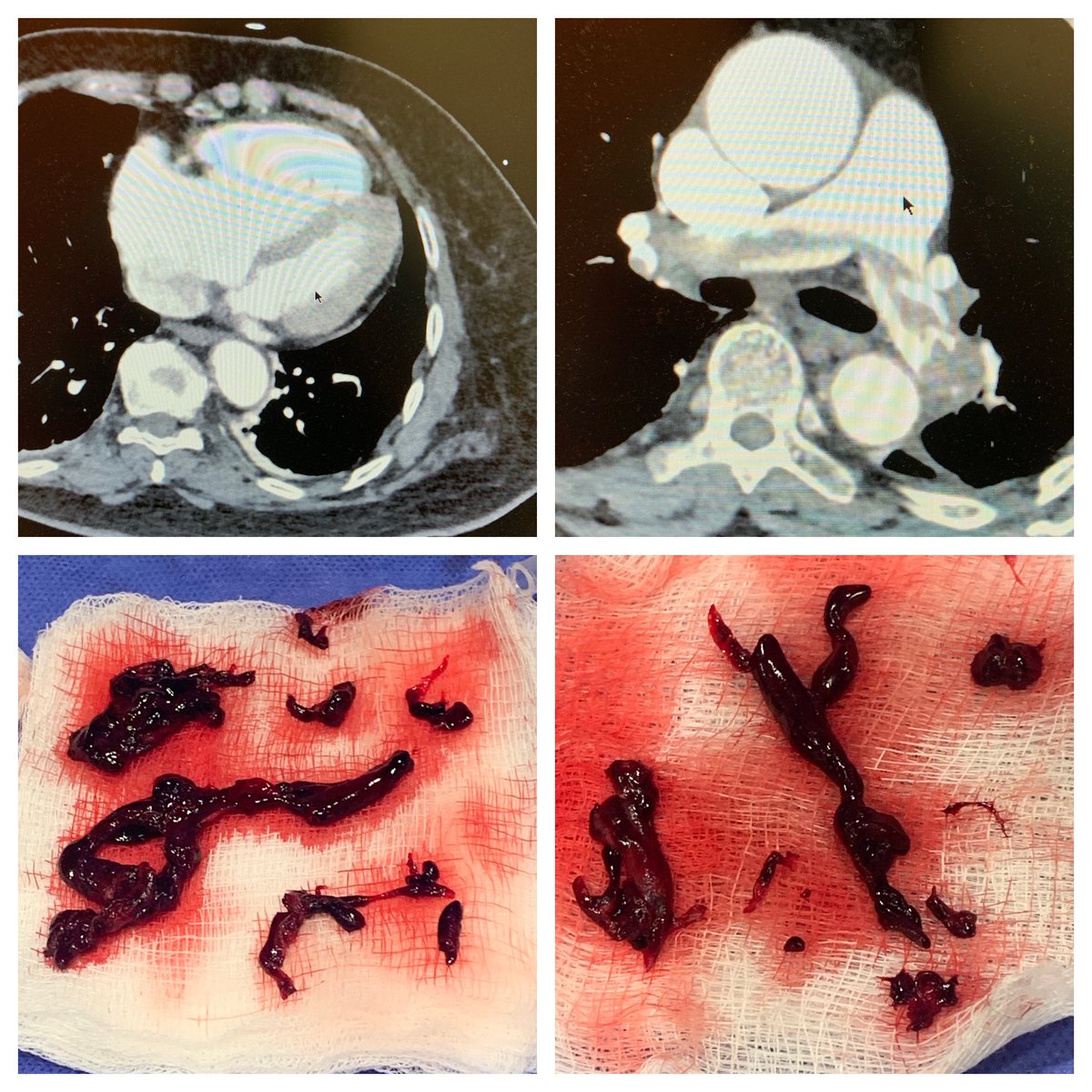 Steve Attanasio (@steveachicago) on Twitter photo Submassive Saddle PE with Spinal Mets and Cord Compression s/p Mechanical Thrombectomy using the T24 Inari FlowTriever; #RUSHPERT and special thanks to Dr.Arslan and our IR colleagues @JayKavinsky <a href="/hsuradi/">Hussam Suradi</a> <a href="/RushMedical/">Rush University System for Health</a> <a href="/fareedmoses/">Fareed Moses Collado, MD FACC FSCAI</a> <a href="/avolgman/">AnnabelleVolgman MD</a> <a href="/RupaSanghaniMD/">Rupa Sanghani</a> Submassive Saddle PE with Spinal Mets and Cord Compression s/p Mechanical Thrombectomy using the T24 Inari FlowTriever; #RUSHPERT and special thanks to Dr.Arslan and our IR colleagues @JayKavinsky <a href="/hsuradi/">Hussam Suradi</a> <a href="/RushMedical/">Rush University System for Health</a> <a href="/fareedmoses/">Fareed Moses Collado, MD FACC FSCAI</a> <a href="/avolgman/">AnnabelleVolgman MD</a> <a href="/RupaSanghaniMD/">Rupa Sanghani</a>