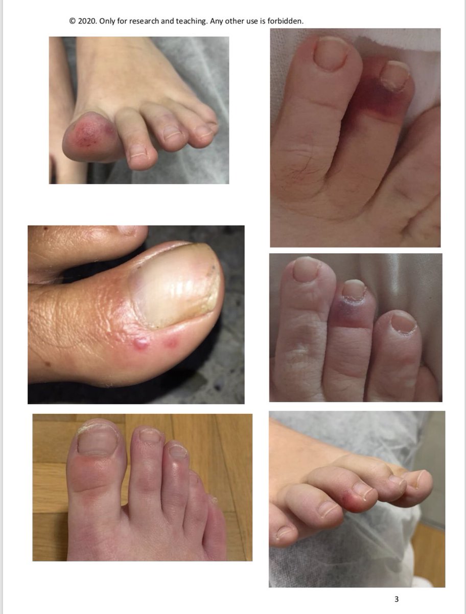 No os perdáis el fantastico atlas recopilación de lesiones en la piel #COVID__19. El mejor hasta el momento. Es antológico.