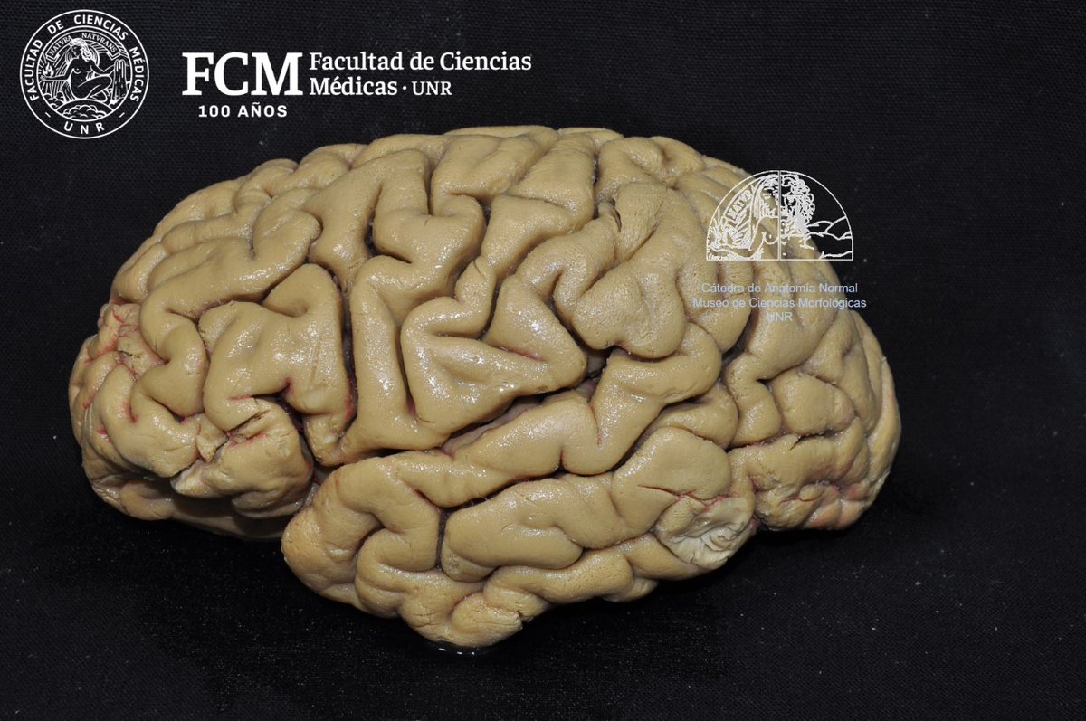 anatomiafcmunr's tweet photo. 💀 DISECCIÓN DE FIBRAS BLANCAS DEL CEREBRO ‼️ A cargo del Departamento de Neurociencias del Museo de Anatomía de la Facultad de Ciencias Medicas - UNR 💀 https://t.co/l6pY2Cn2JT
