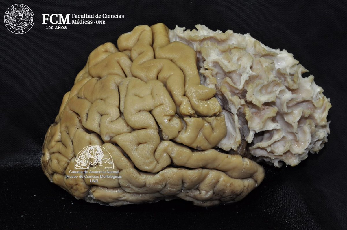 anatomiafcmunr's tweet photo. 💀 DISECCIÓN DE FIBRAS BLANCAS DEL CEREBRO ‼️ A cargo del Departamento de Neurociencias del Museo de Anatomía de la Facultad de Ciencias Medicas - UNR 💀 https://t.co/l6pY2Cn2JT