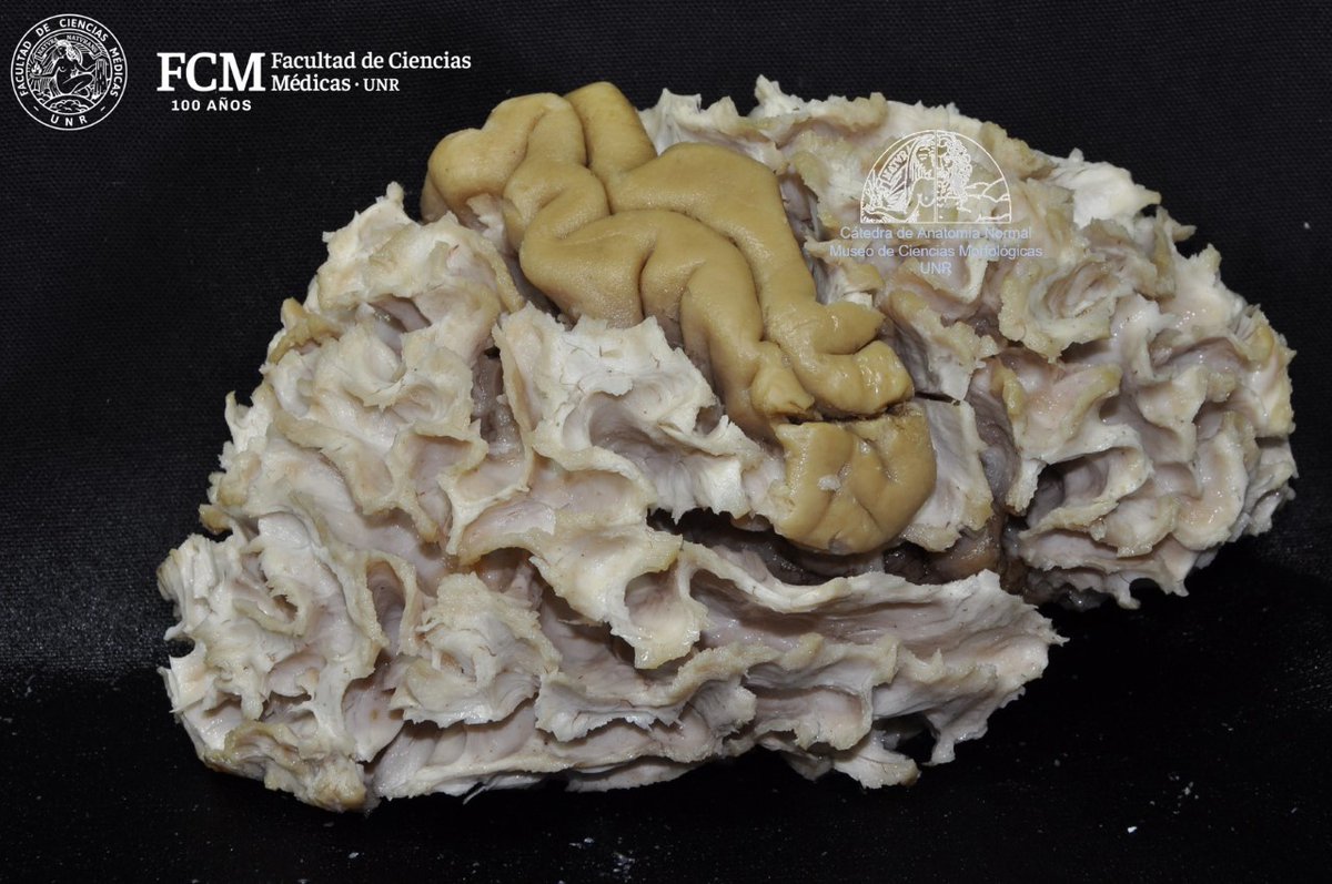 anatomiafcmunr's tweet photo. 💀 DISECCIÓN DE FIBRAS BLANCAS DEL CEREBRO ‼️ A cargo del Departamento de Neurociencias del Museo de Anatomía de la Facultad de Ciencias Medicas - UNR 💀 https://t.co/l6pY2Cn2JT