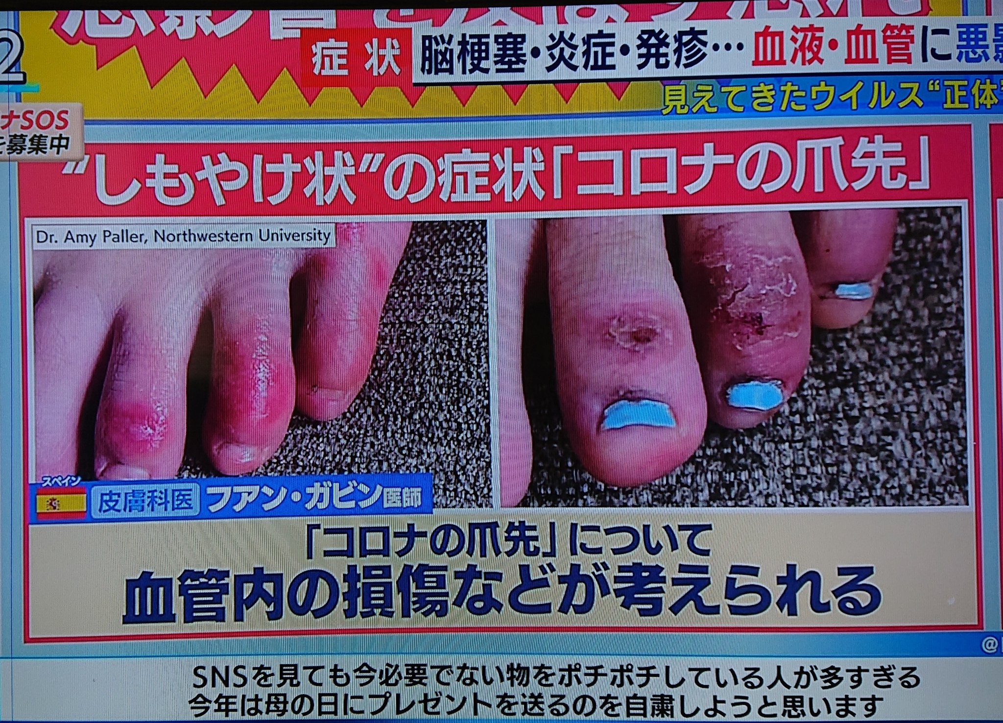 Michru まじねこ בטוויטר 新型コロナ症状 足の指先先にしもやけ状の症状 新型コロナ症状