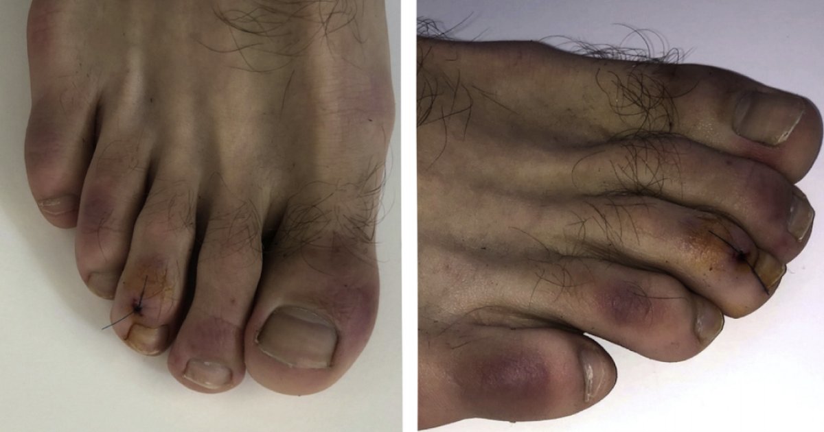 Norfolk_NC's tweet photo. Norfolk News "COVID toes" and other skin symptoms may be a sign of coronavirus - CBS News https://t.co/YvyeCrmDuD https://t.co/XN2OHl5vFg