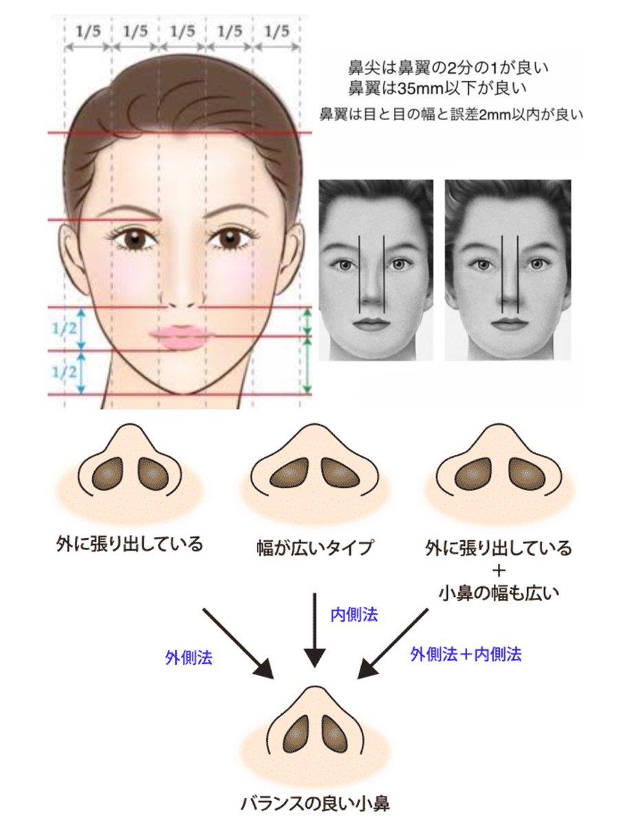 アネモネ 小鼻縮小 鼻翼は目と目の幅誤差2mm以内が綺麗とされる 外側法 小鼻の張り出しが強い人向き 傷目立ちやすい 内側法 鼻の穴が小さくなる傾向 やりすぎ リプ欄参照 外側法と比べて傷目立ちにくい やりすぎないためには 術者のデザインと