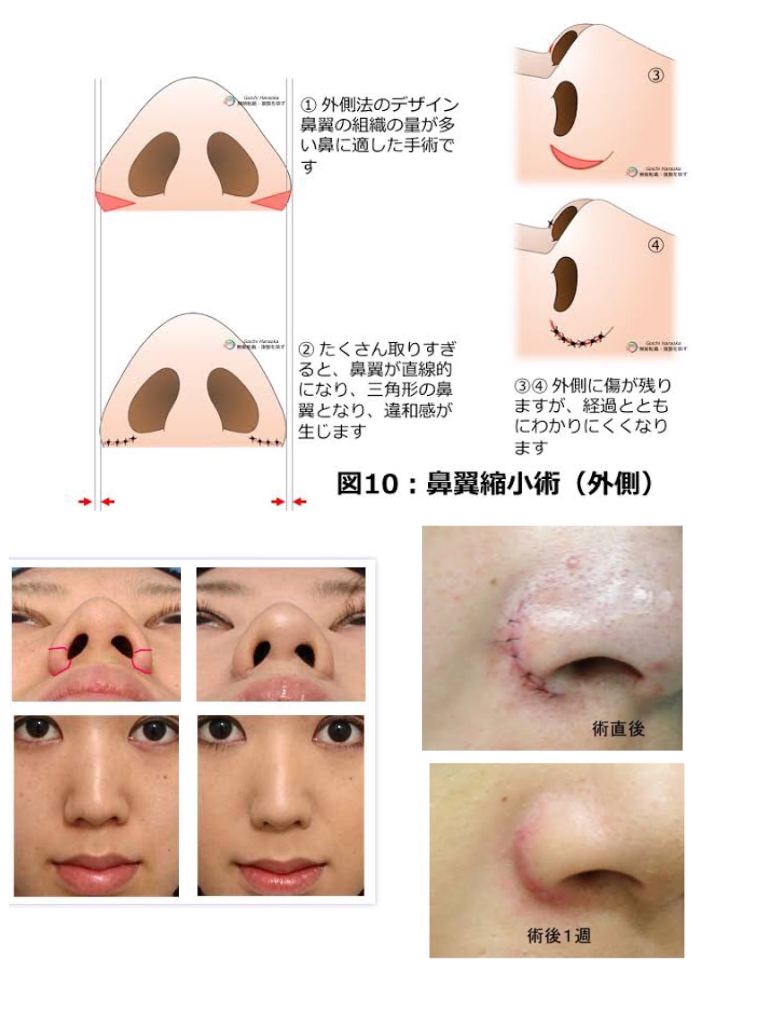 アネモネ 小鼻縮小 鼻翼は目と目の幅誤差2mm以内が綺麗とされる 外側法 小鼻の張り出しが強い人向き 傷目立ちやすい 内側法 鼻の穴が小さくなる傾向 やりすぎ リプ欄参照 外側法と比べて傷目立ちにくい やりすぎないためには 術者のデザインと アネモネ 小鼻縮小 鼻翼は目と目の幅誤差2mm以内が綺麗とされる 外側法 小鼻の張り出しが強い人向き 傷目立ちやすい 内側法 鼻の穴が小さくなる傾向 やりすぎ リプ欄参照 外側法と比べて傷目立ちにくい やりすぎないためには 術者のデザインと