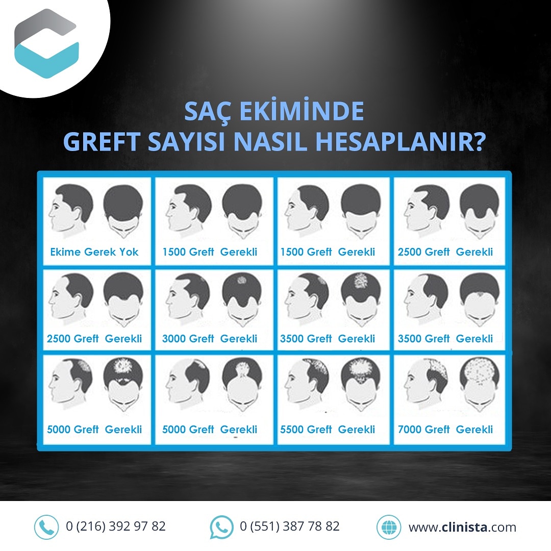 clinista's tweet photo. Saç ekiminde greft sayısı nasıl hesaplanır?👨‍⚕
#microfue #sacekimi #sacdokulmesi #hairlove #hairlosssolution #hair #saçekimi #medicaltourism #trapiantodicapelli #trasplantecapilar #prphairrestoration #hairtransplant #istanbul #turchia #roma #suadiye #bağdatcaddesi #türkiye https://t.co/FZotpbjRHt