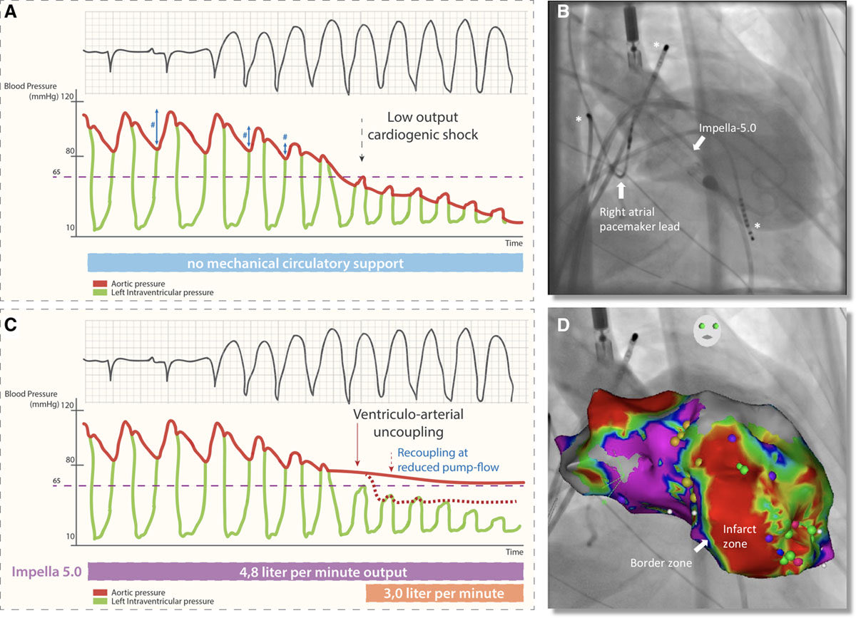 The concept of Impella unloading and ventriculoarterial uncoupling explained - Castelein et al., Circ. HF, 01/05 <a href="/UZLeuven/">UZ Leuven</a> @abiomedimpella <a href="/CMVB_KULeuven/">Center for Molecular and Vascular Biology</a> <a href="/AICU_RBH/">Royal Brompton Critical Care</a> <a href="/AHAScience/">AHA Science</a>