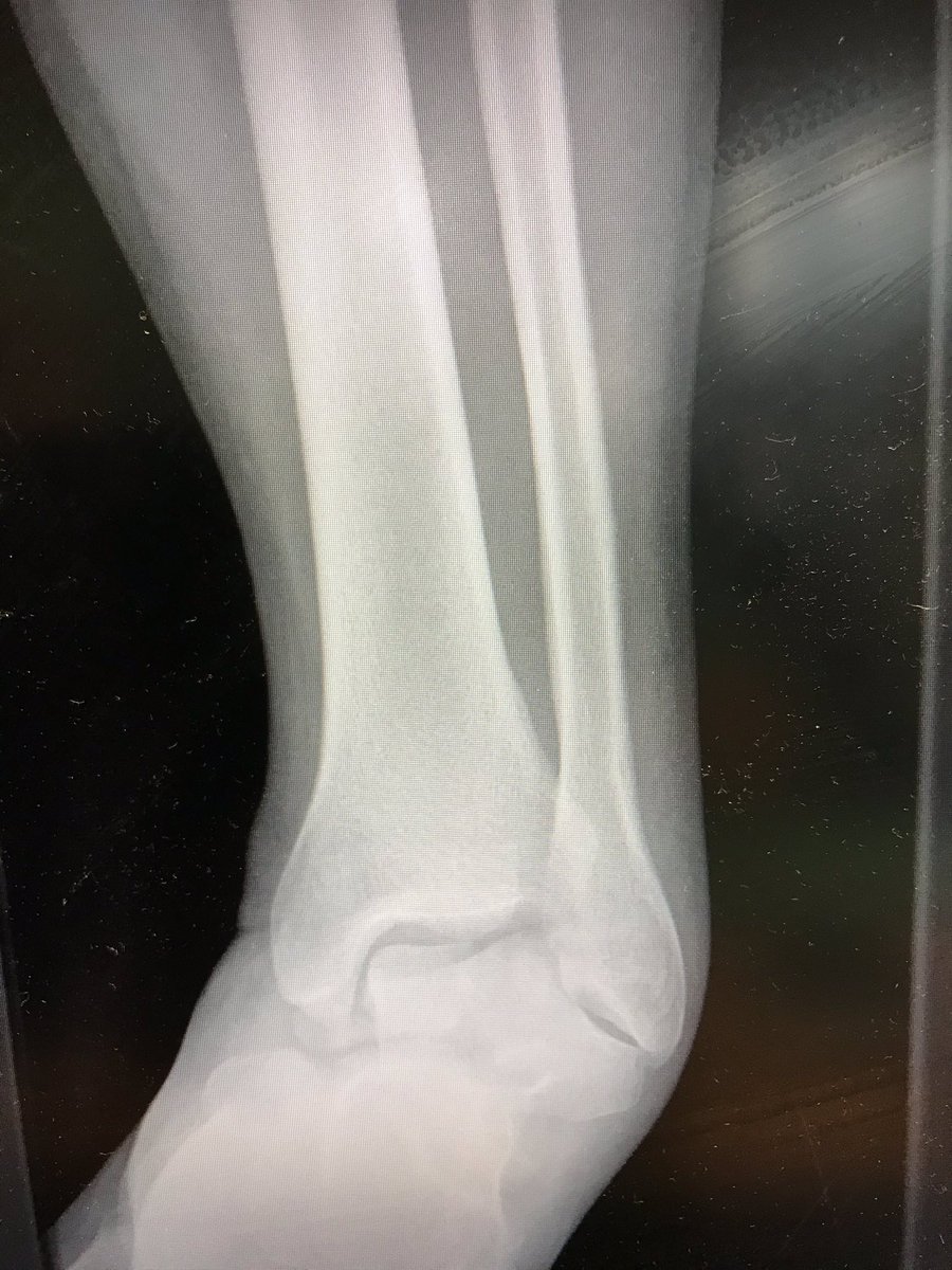 Jacobs_surgeon's tweet photo. Be careful what you wish for....
With no elective surgery over recent weeks I’d been missing doing foot and ankle surgery. Then this came in. (Shared with patient consent)
#fracturedislocation #talus #orthotwitter #fracturefriday https://t.co/4UZJ89JRxh