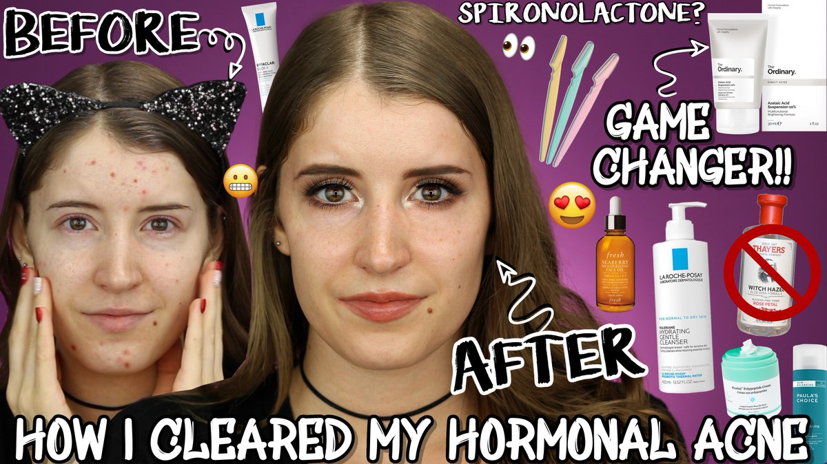 HOW I CLEARED MY SKIN FAST! HORMONAL ACNE SKINCARE ROUTINE 😍
Watch Here 👉 youtu.be/3OrdigSt3ps
#skincareroutine #hormonalacne #acnetreatment #skincare #skincaretips #acne #AcneClear