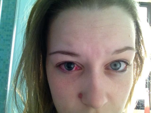 SalvageWriter's tweet photo. @ChuckWendig Got shot in the eye with a toy cross bow in 2014, hurt like hell but I was fine, but my pupils are slightly different sizes now (not as obvious as this picture though) https://t.co/ZQbFRHDjR0