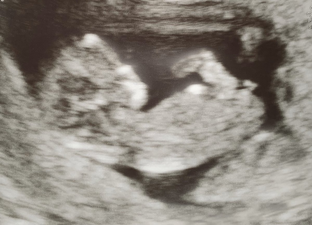 csmillar10's tweet photo. Amy Percy and I would like to introduce you to mini Millar! Can’t wait to meet you in 20 weeks! Due date 18/09/20 #theworldisnotready https://t.co/lv6Uosk0bp