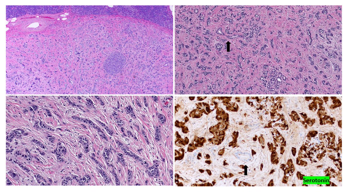 OlcaBasturk's tweet photo. Serotonin-producing PanNETs are rare but reveal a very typical morphology. Trabecular growth &amp; extensive stromal fibrosis (rare in other PanNETs) are your clues. Dont let the entrapped B9 ducts -arrows- to mislead. Serotonin IHC is + in neuorendocrine cells only #PanNET https://t.co/pskByUWnDF
