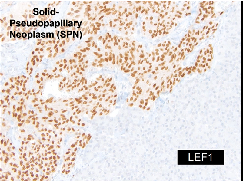 javidiparsijani's tweet photo. I never knew that #CLL and #SPN in pancreas are both positive for LEF-1. Thanks to #virtuallectureseries #CAP @PancPathologist neoplasms of pancreas https://t.co/RFGtosOxwj
