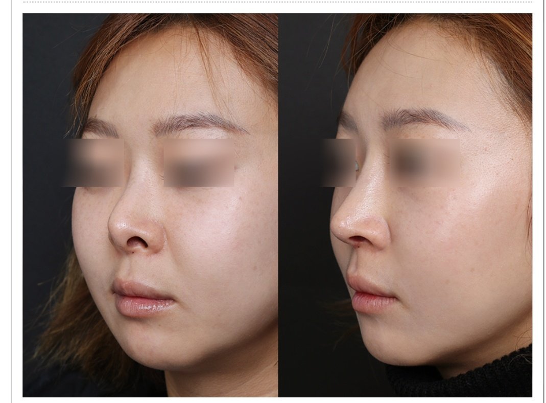 Korea Beauty Consultant Rivga ドナン整形外科 美的なセンスが優れている先生に任せるともっと満足度が高いと思います 短い鼻 鼻孔矯正 コンプレックス 団子鼻 小鼻举上 小鼻糸縛り 耳介軟骨 肋骨 鼻の再手術 鼻整形 Rivga 医療専門知識