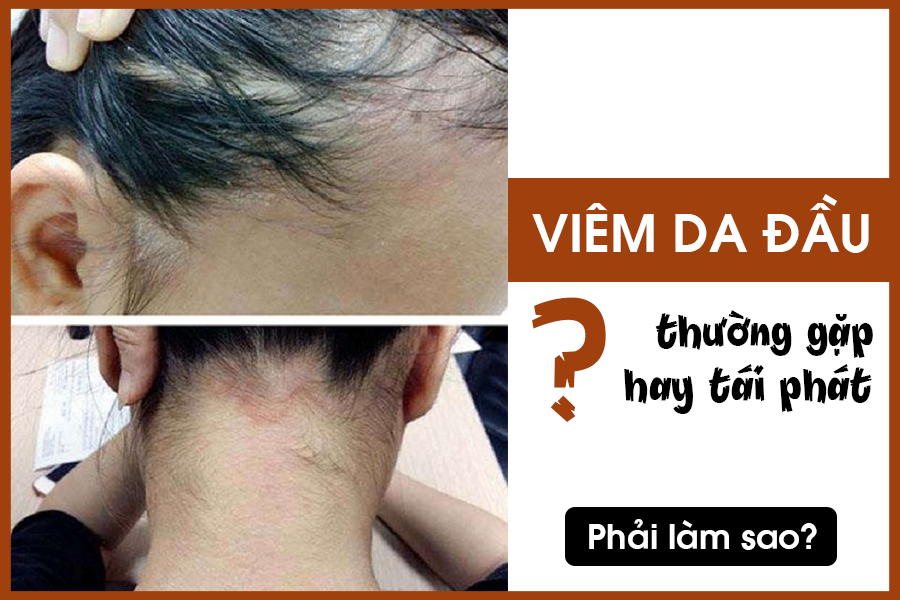 jakata1982's tweet photo. Bệnh viêm da đầu do nhiều tác nhân gây ra và khá thường gặp; đặc biệt với người có đặc trưng da đầu nhiều dầu nhờn. Để chữa viêm da đầu ngứa ngáy, nhiều người bệnh tìm đến các loại thuốc Tây y. https://t.co/ZAjgreTehd https://t.co/bH9o1VbCP3