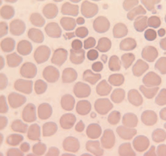 4. Spherocytes are as the name suggests, spherical rather than being disc shaped. They are cells that have lost membrane without equivalent loss of cytosol and appear dense / dark on the film. The SEM image shows stages from discocyte to spherocyte. #MorphologyMonday