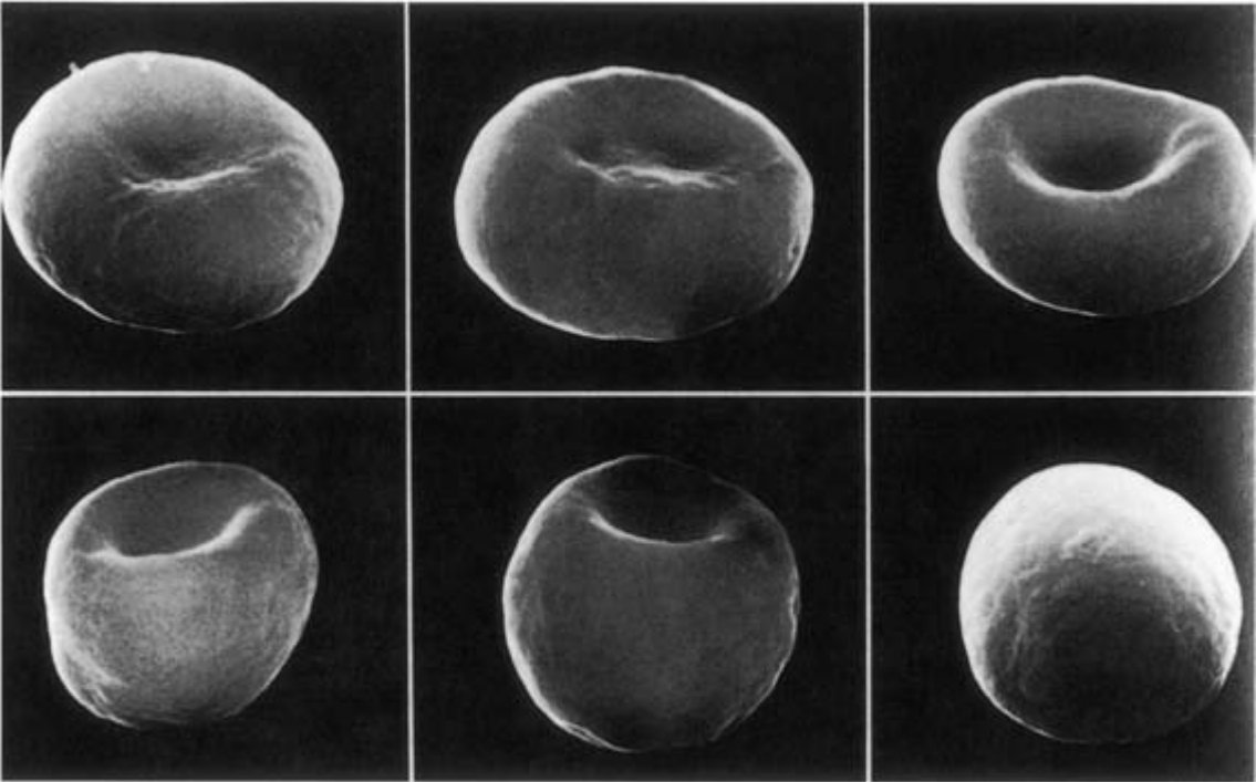 4. Spherocytes are as the name suggests, spherical rather than being disc shaped. They are cells that have lost membrane without equivalent loss of cytosol and appear dense / dark on the film. The SEM image shows stages from discocyte to spherocyte. #MorphologyMonday