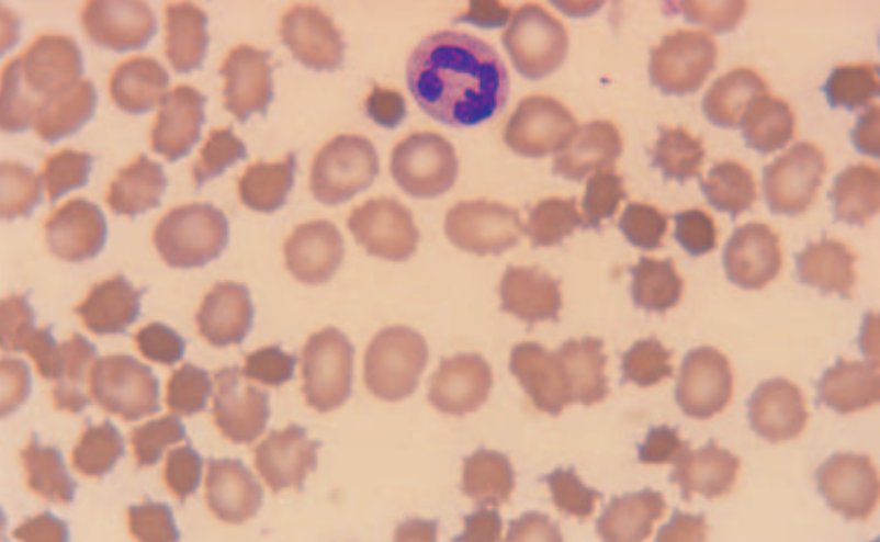 7. Acanthocytes are red cells bearing between 2-20 spicules that are of unequal length and distributed irregularly over the red cell surface. They're seen in abetalipoproteinaemia or liver disease, where cholesterol : phospholipid in red cells increases.  #MorphologyMonday