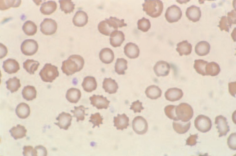 6. Echinocytes are red cells that have lost their distinct disc shape and are covered with 10–30 short blunt regular spicules. There are various reasons why they form including HUS, PK deficiency, storage artefact, liver disease and following burns for eg. #MorphologyMonday