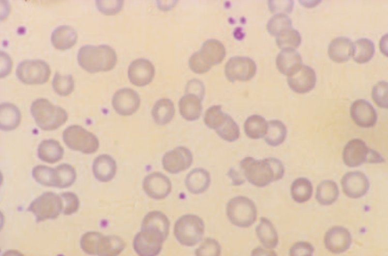 8. Keratocytes or 'horned cells' usually have 2 / up to 4/6 spicules after opposing membranes fuse forming a pseudovacuole which then ruptures. These are seen in mechanical damage of the cells, MAHA, DIC, renal disease and after removal of Heinz bodies. #MorphologyMonday