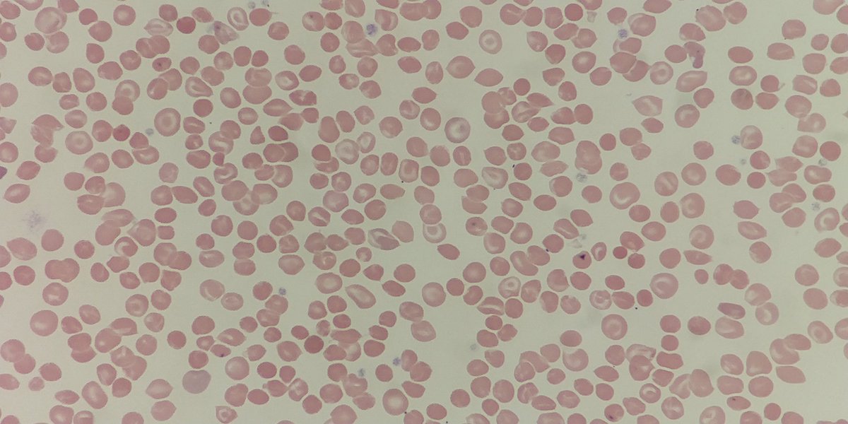 9. Target cells appear  #underthescope as having an area of increased staining in the middle giving a  like appearance. They are thinner than normal cells. In vivo they appear bell shaped but flatten on spreading giving the characteristic target shape.  #MorphologyMonday