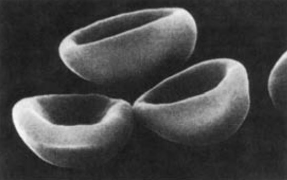 10. Stomatocytes appear having a central linear slit of stoma  #underthescope. In wet preps or scanning micrographs, they appear as being cup or bowl shaped. They are noted in vitro (low pH / chlorpromazine use) or in (alcoholic) liver disease amongst others. #MorphologyMonday