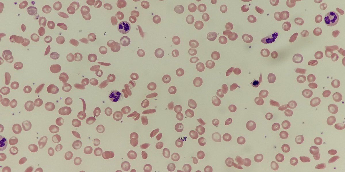 11.  #Sickle cells are seen in sickle cell anaemia or sickle cell disease. They are crescent or sickle shaped with pointed ends.  #Underthescope they may also appear boat shaped. #MorphologyMonday