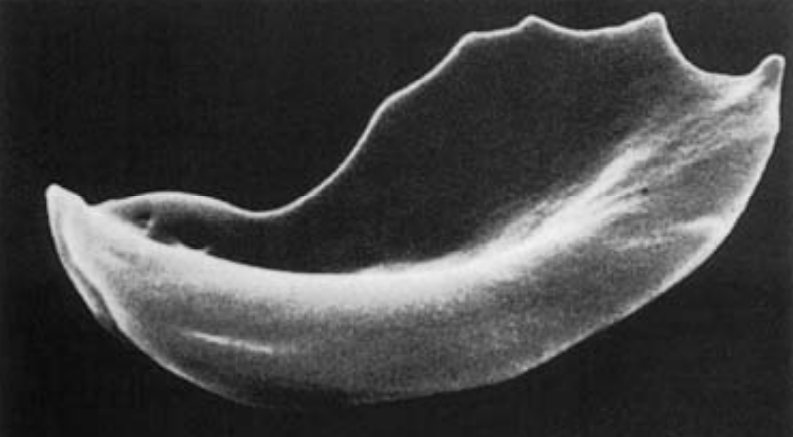 11.  #Sickle cells are seen in sickle cell anaemia or sickle cell disease. They are crescent or sickle shaped with pointed ends.  #Underthescope they may also appear boat shaped. #MorphologyMonday