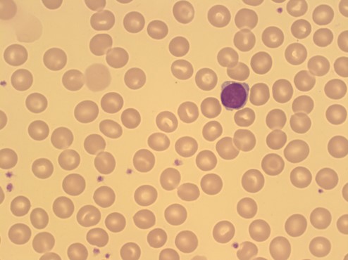 2. Normal red blood cells (erythrocytes) are disciform / biconcave in shape and appear on the blood film with a lighter area in the middle known as 'central pallor'. This usually spans 1/3 of the diameter of the cell. #MorphologyMonday