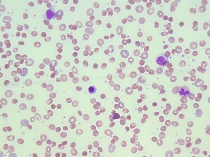 3. Reticulocytes are usually larger than normal red blood cells and they appear blueish due to staining of residual ribosomal RNA left after the nucleus is removed. Only the most immature reticulocytes appear polychromatic (blueish). #MorphologyMonday