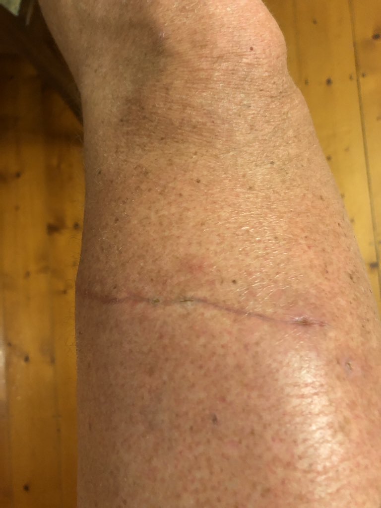 Three weeks since my tangle with a chainsaw . good as new , well almost 💪