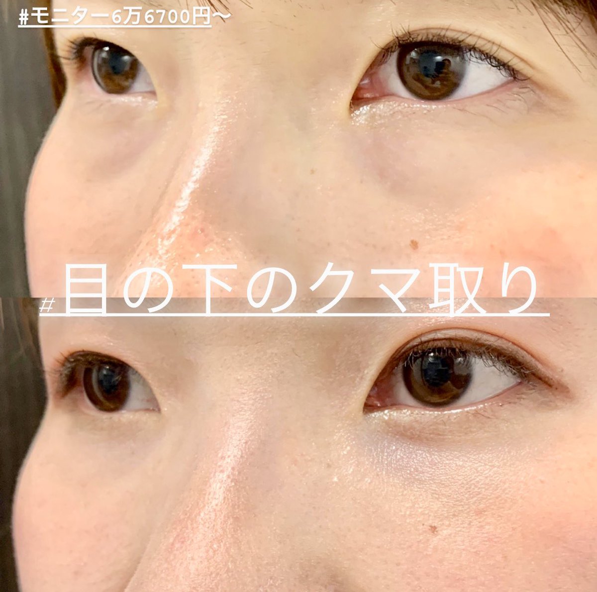 糸リフト 二重整形 鼻整形 ルラ美容クリニック院長 武内大 בטוויטר 目の下のクマ ふくらみ取り 目の下のクマ ふくらみが改善して若々しくなりましたね 目の下のクマ ふくらみが改善すると若返ります もちろん脂肪注入の併用なしです 脂肪注入なしで綺麗に