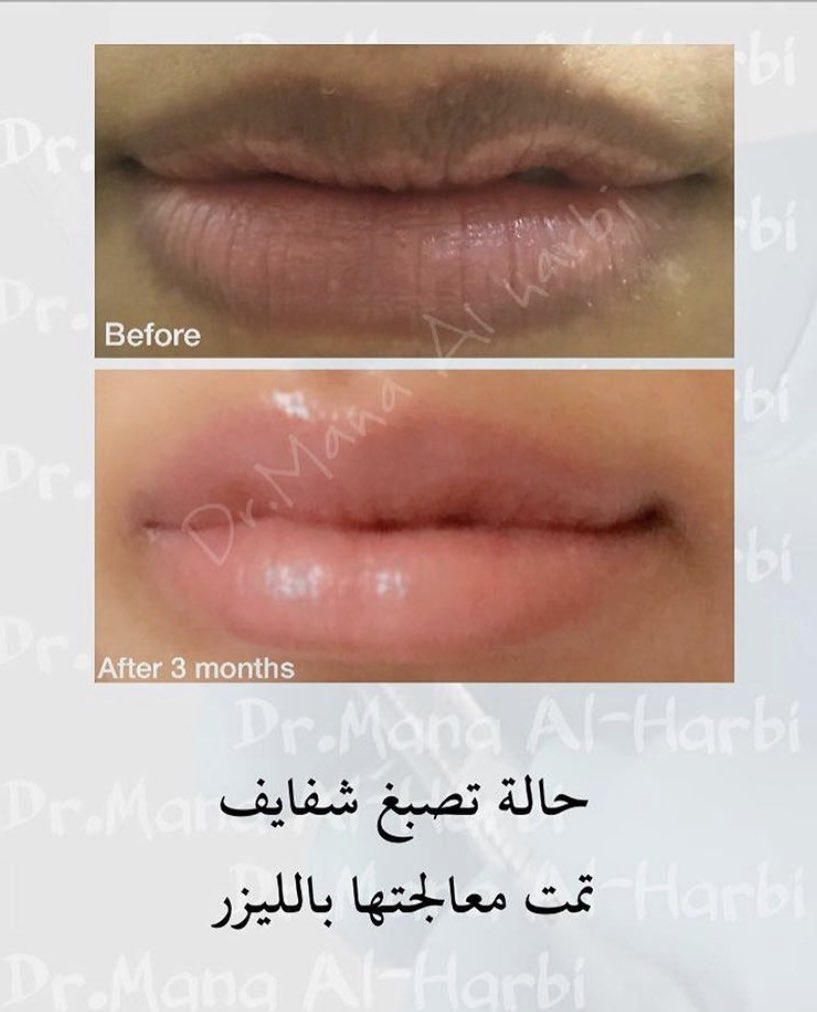Uzivatel د مانع الحربي Na Twitteru الليزر يستخدم لعلاج تصبغ الشفايف سواء كان وراثي او بسبب عوامل اخرى مثل التدخين عودة التصبغ بعد العلاج ممكنه خاصة عند المدخنين افضل انواع الليزر ل الشفايف