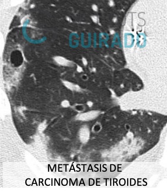 inst_guirado's tweet photo. Cuando todo es lo mismo pero nada es igual. Diagnostico diferencial SARS-CoV-2. Dr. @JORDICATMARCH 
#Covid_19 #medicina #tctorax #xray #radiologia #radiology #tsid #radiographer #torax https://t.co/bAgL4oDLNx