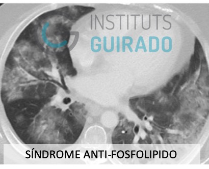 inst_guirado's tweet photo. Cuando todo es lo mismo pero nada es igual. Diagnostico diferencial SARS-CoV-2. Dr. @JORDICATMARCH 
#Covid_19 #medicina #tctorax #xray #radiologia #radiology #tsid #radiographer #torax https://t.co/bAgL4oDLNx