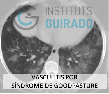 inst_guirado's tweet photo. Cuando todo es lo mismo pero nada es igual. Diagnostico diferencial SARS-CoV-2. Dr. @JORDICATMARCH 
#Covid_19 #medicina #tctorax #xray #radiologia #radiology #tsid #radiographer #torax https://t.co/bAgL4oDLNx
