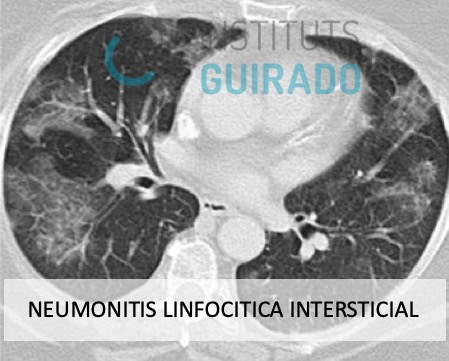 inst_guirado's tweet photo. Cuando todo es lo mismo pero nada es igual. Diagnostico diferencial SARS-CoV-2. Dr. @JORDICATMARCH 
#Covid_19 #medicina #tctorax #xray #radiologia #radiology #tsid #radiographer #torax https://t.co/bAgL4oDLNx