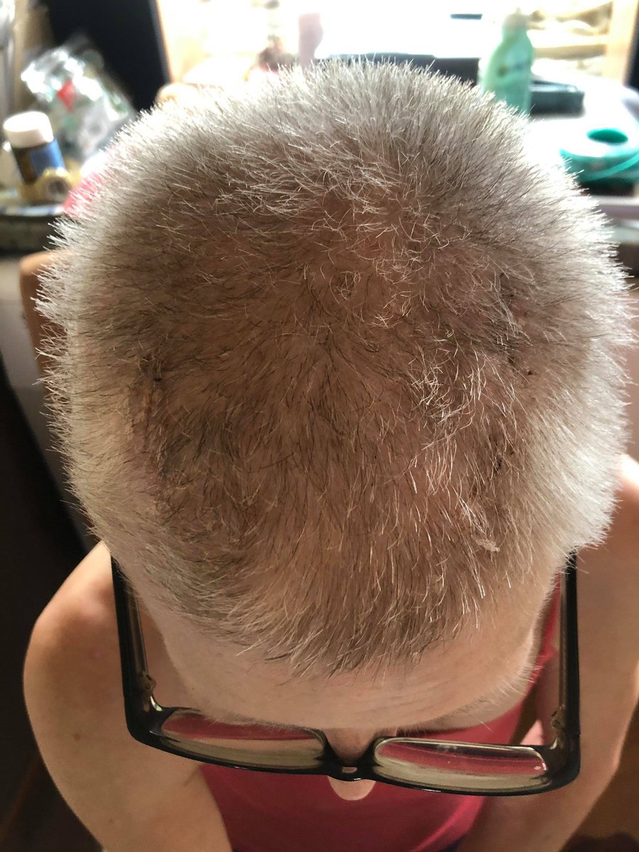 My hairs growing after having #MondayMotivation #DBS #brainsurgery. #ParkinsonsAwarenessMonth #Parkinson #hairstyle #Growth #colour