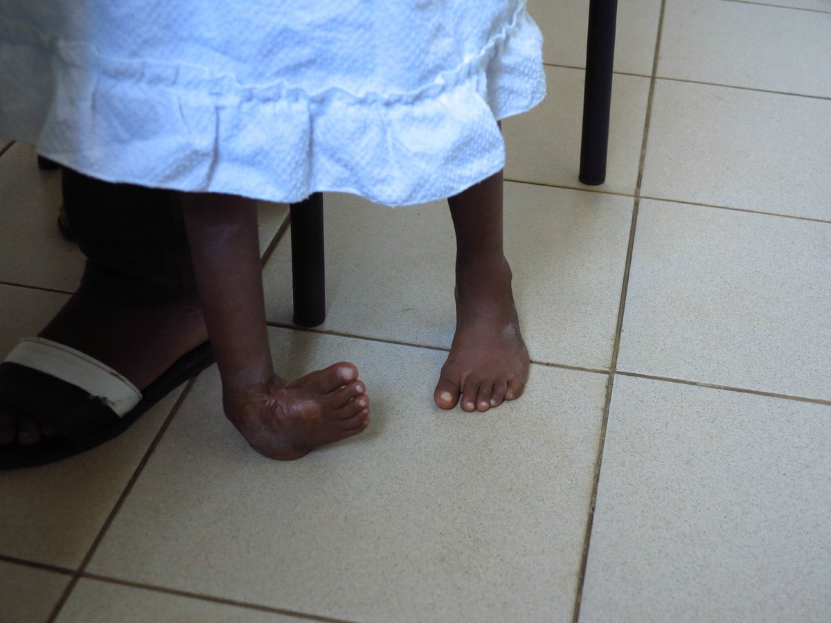 MagazineJimbere's tweet photo. 🔴 La malformation congénitale du pied appelée "#pied_bot" est facilement traitable quand on le détecte très tôt. Mais il nécessite une intervention chirurgicale plus complexe à l’âge adulte
▶️ https://t.co/tQtNzhnGCp
#Burundi #Santé https://t.co/3i6rfsrYmO