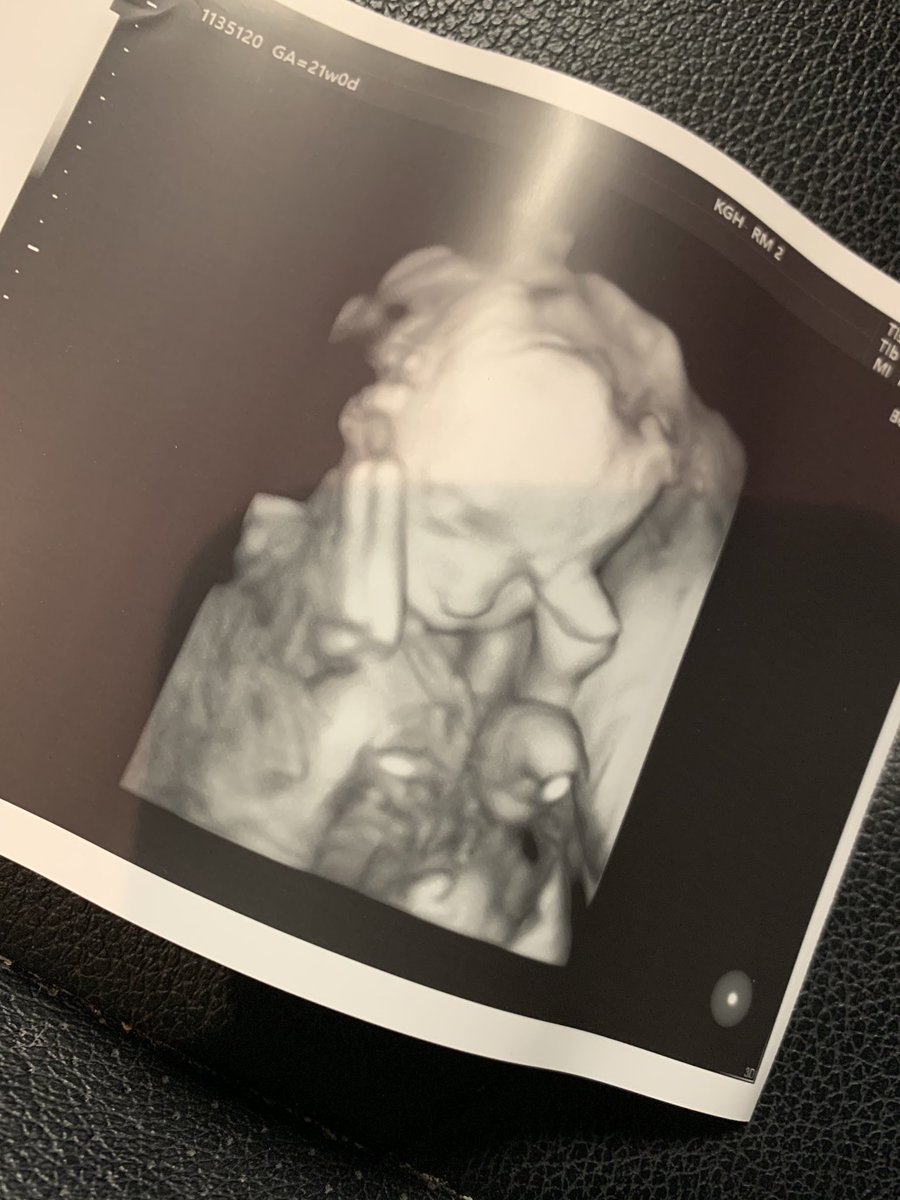DiannaahE's tweet image. 21 weeks today! Anatomy scan today! A precious looking 3D Scan of mamas baby boy Caysen 😍❤️ today is a great day 🙈 #babyboythree #boymamaforlife #anatomyscan